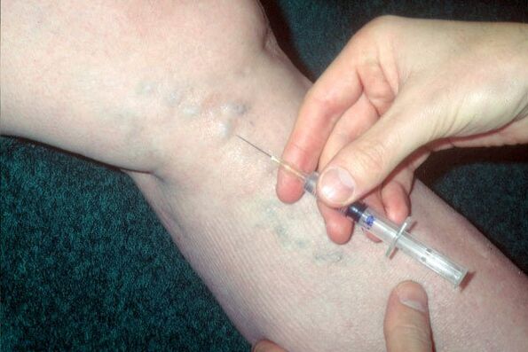 skleroterapija proširenih vena