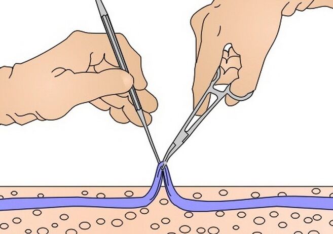 skidanje vena za proširene vene